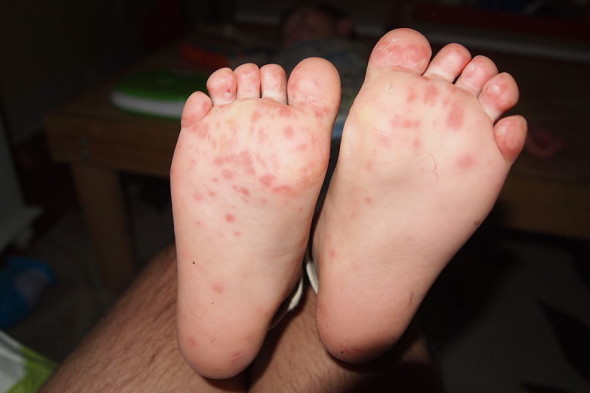 Hand-Foot-and-Mouth Disease-Topic Overview - WebMD