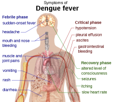 dengue fever pain